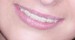 my braces 2